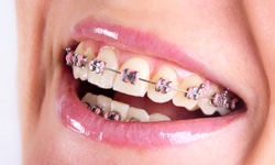 metal rubber bands for braces