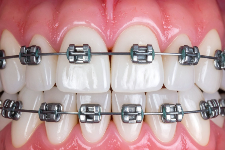 Close-up of teeth with metal braces