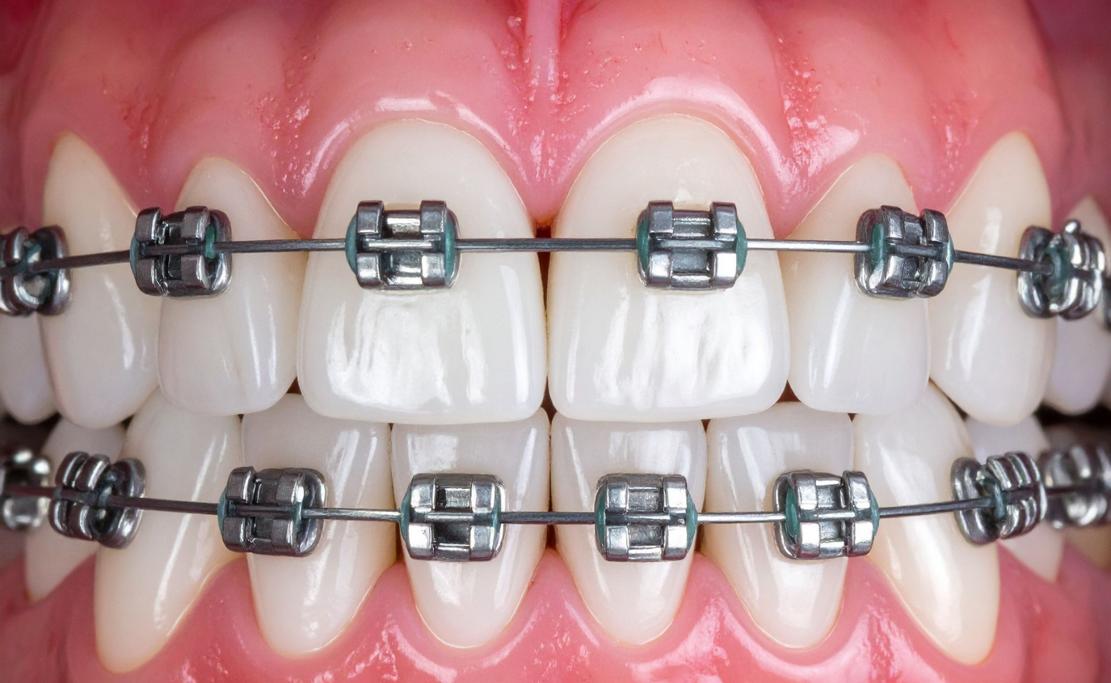 What Braces Actually Cost in Reno, NV (2026 Prices)