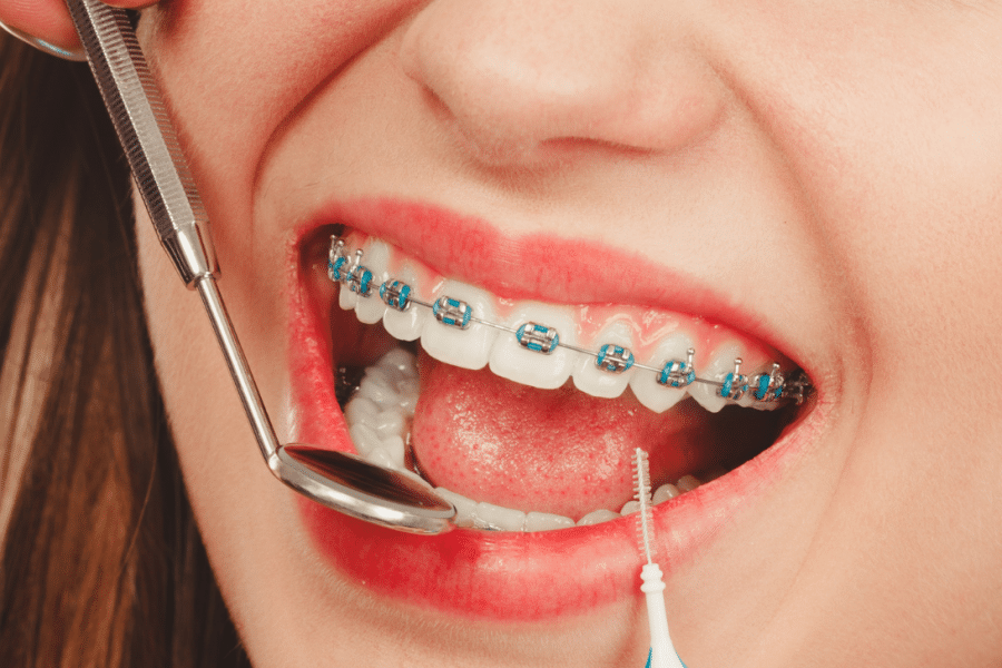 Close-up of dental braces being examined